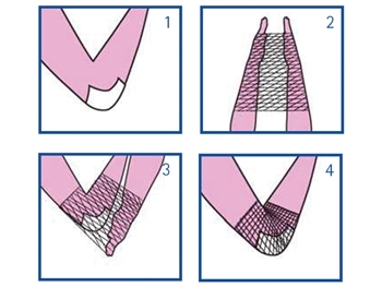 Rete tubolare elastica calibro 3